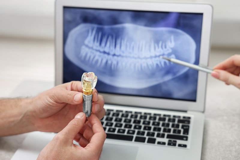 A dental professional holds a dental implant model while pointing at a dental X-ray on a laptop screen. This image emphasizes the precision and planning involved in dental implant procedures.