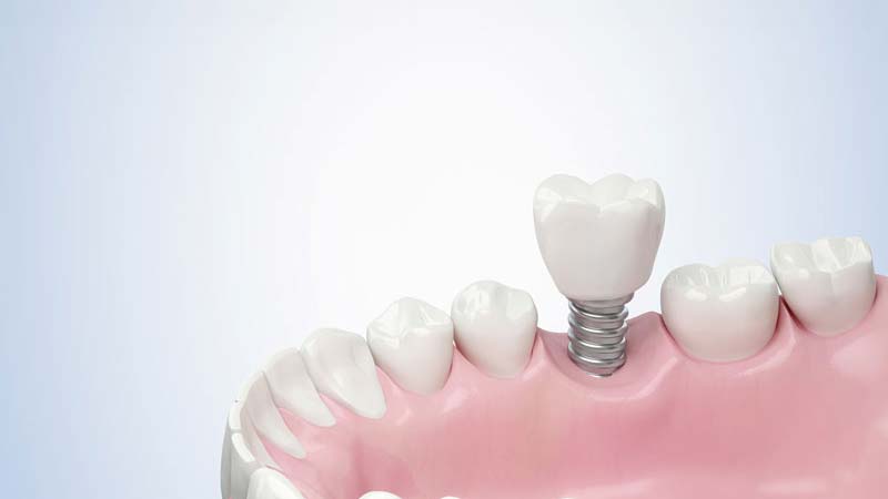 Discover the benefits of dental implants as a complete teeth replacement option. Learn why they're an effective choice at Dr. Michael Sohl Implant & Cosmetic Dentistry.