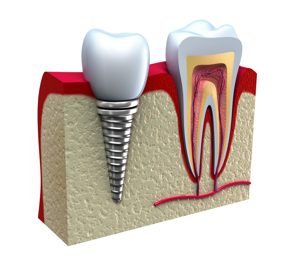 Stuart Dental Implants